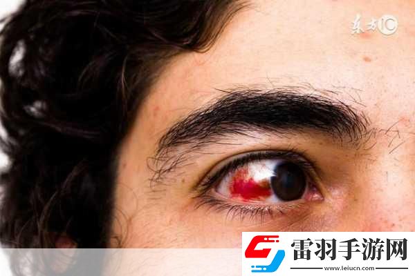 眼睛也會(huì)中風(fēng)。